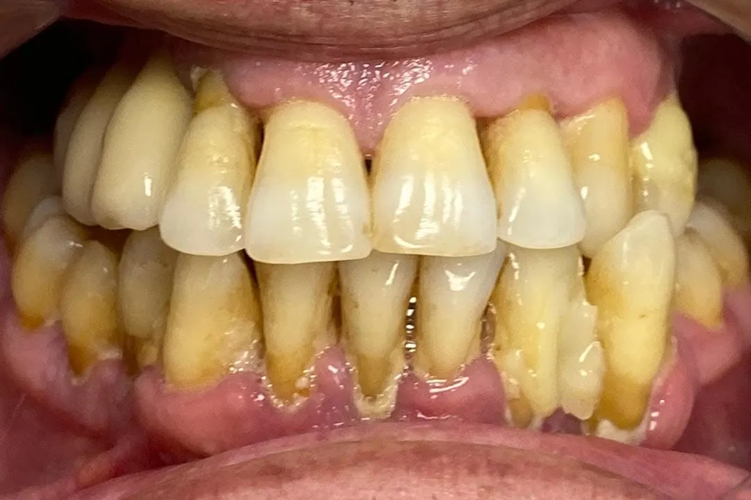 Antes: rehabilitación completa con implantes (caso 03)