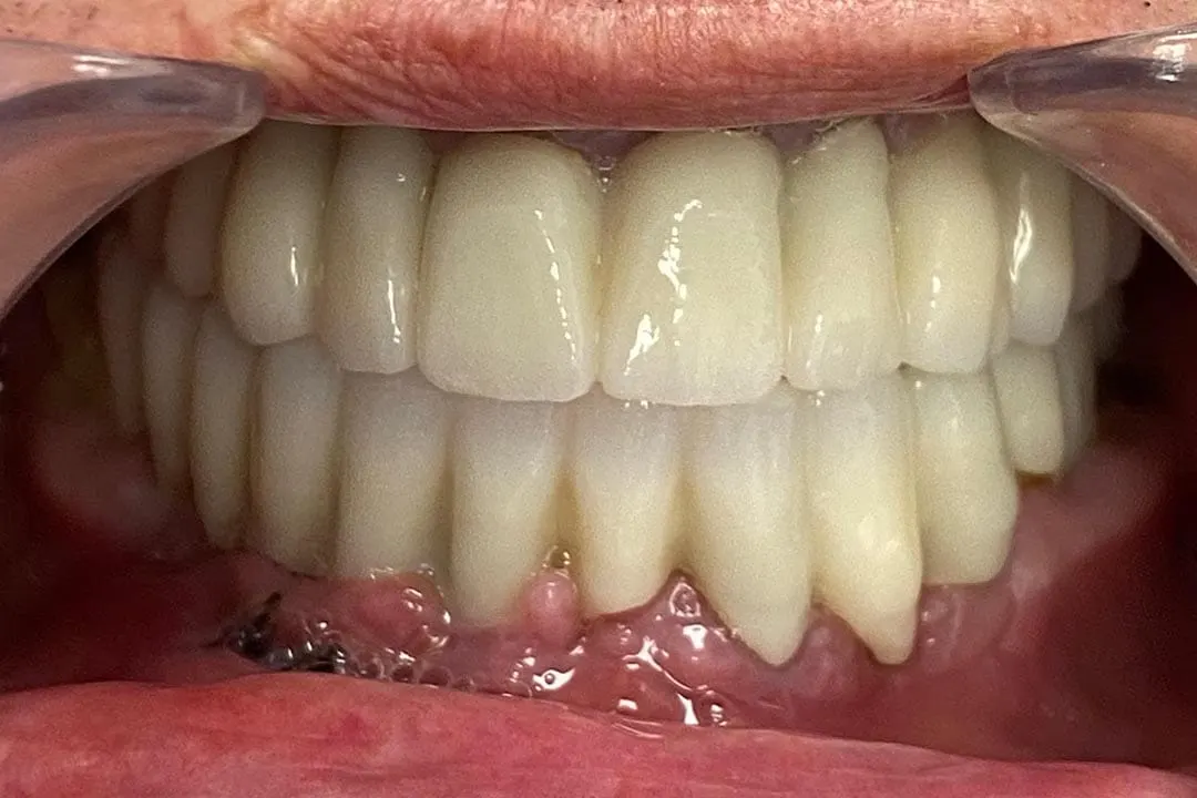 Después: rehabilitación completa con implantes (caso 03)