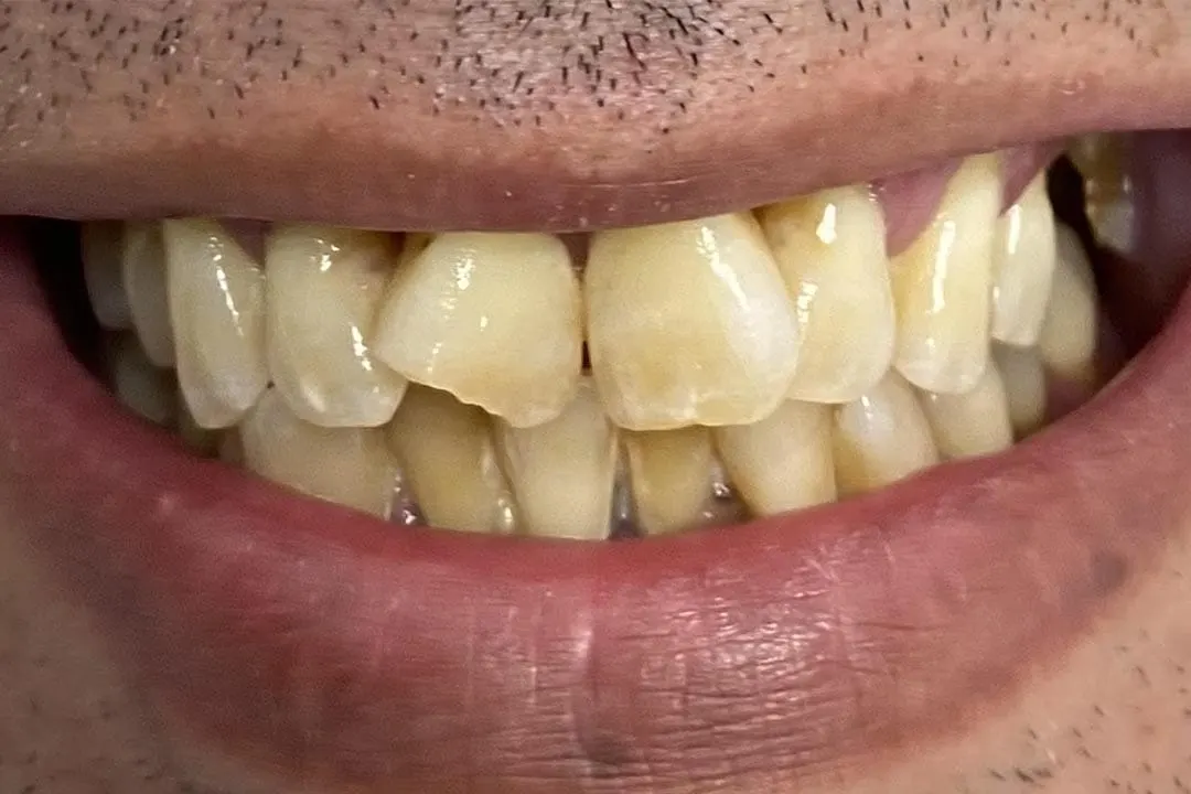 Antes: rehabilitación completa con implantes (caso 05)