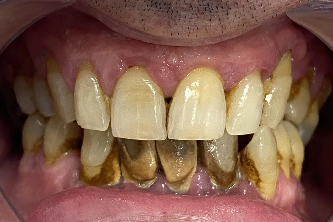 Antes: rehabilitación completa con implantes (caso 09)