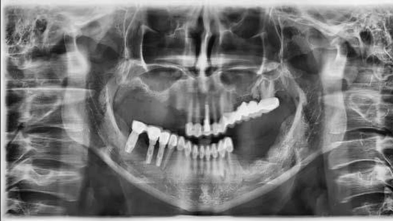Ortopantomografía de control de una rehabilitación completa con prótesis fija sobre implantes basales y cigomáticos.