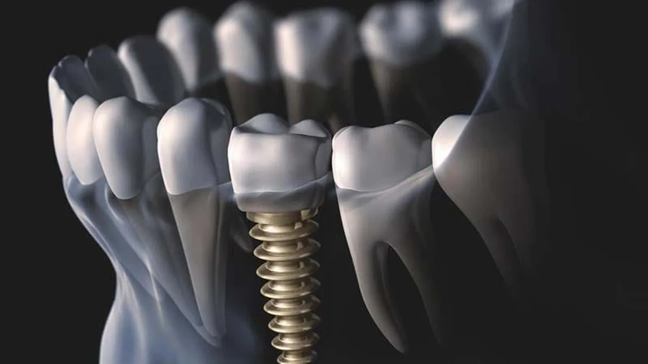 Paciente relajado en el sillón dental durante la colocación de implantes con anestesia local.