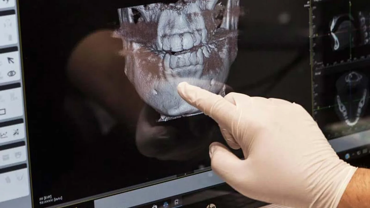 Esquema de implantes basales anclados en el hueso cortical profundo de la mandíbula.
