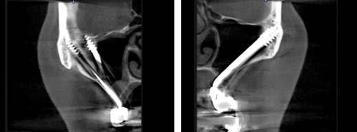 Fig. 4 y 5. Cortes radiográficos del escáner donde se observan los implantes estratégicos cigomaticos ZSI en ambos lados.
