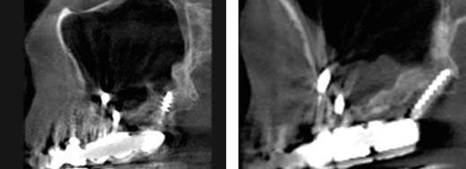 Fig. 5 y 7. Cortes radiográficos del escáner donde se muestran los implantes mas distales, uno con anclaje en la cortical del piso de seno y el otro en la cortical del pterigoides.