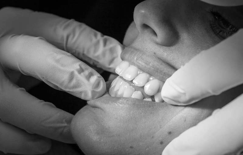 ¿Cómo detectar la periodontitis?