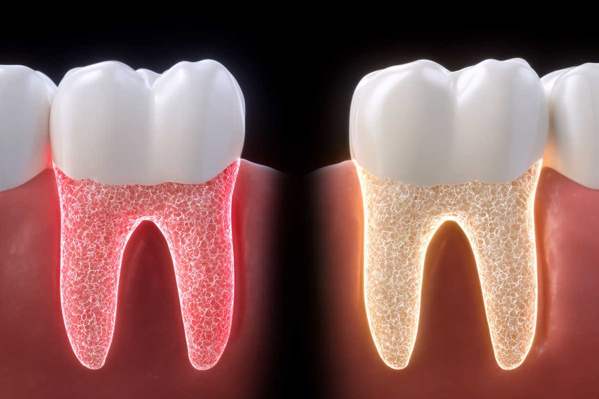 Preservación ósea con implante frente a reabsorción bajo póntico